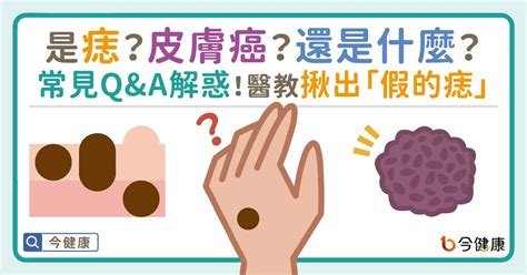 突出來的痣|是痣or皮膚癌？醫「1張圖秒對照」 長這2部位最危險